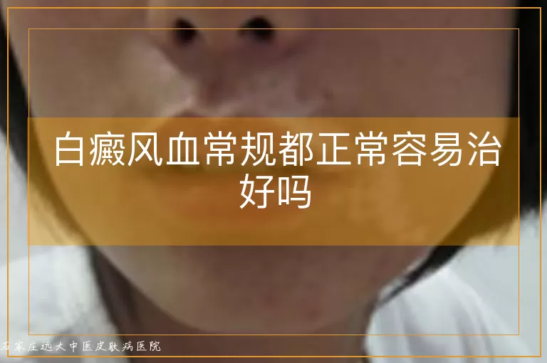 白癜风血常规都正常容易治好吗