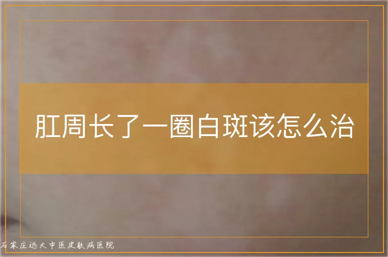 肛周长了一圈白斑该怎么治