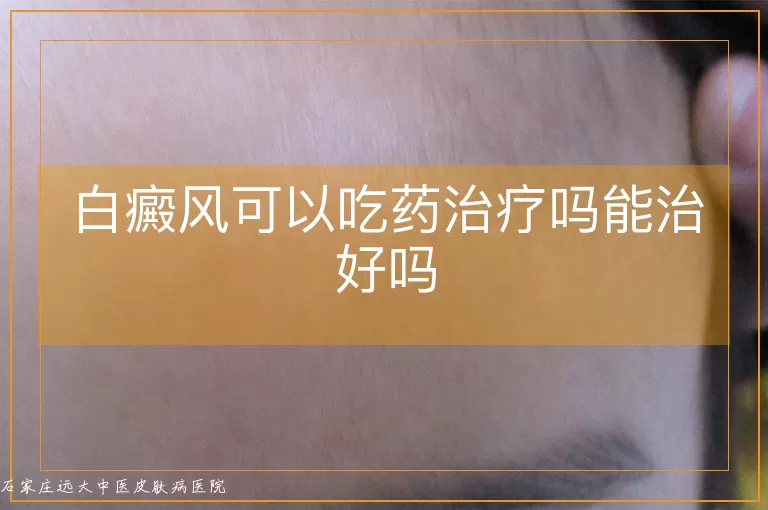 白癜风可以吃药治疗吗能治好吗