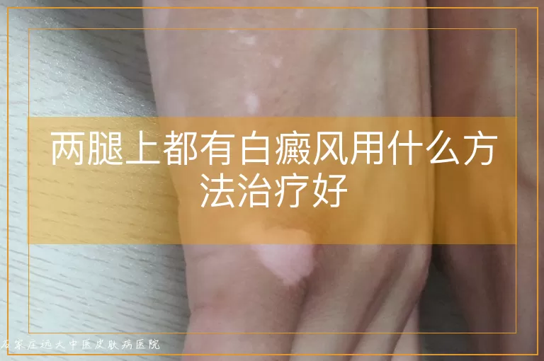 两腿上都有白癜风用什么方法治疗好