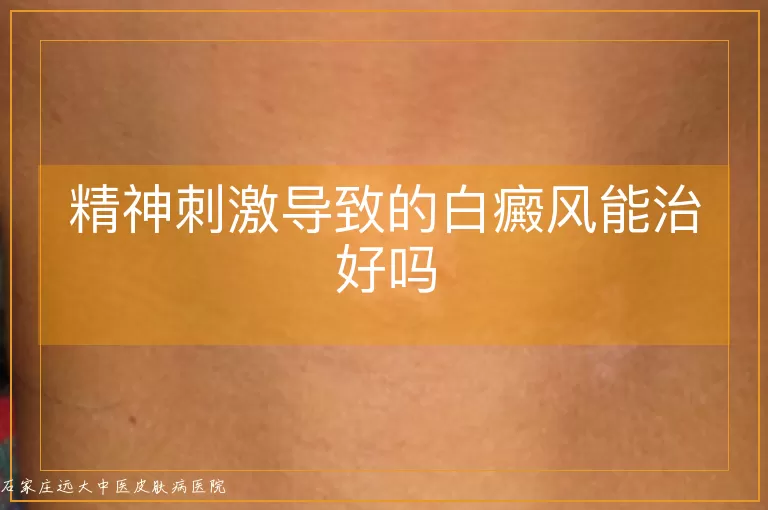 精神刺激导致的白癜风能治好吗