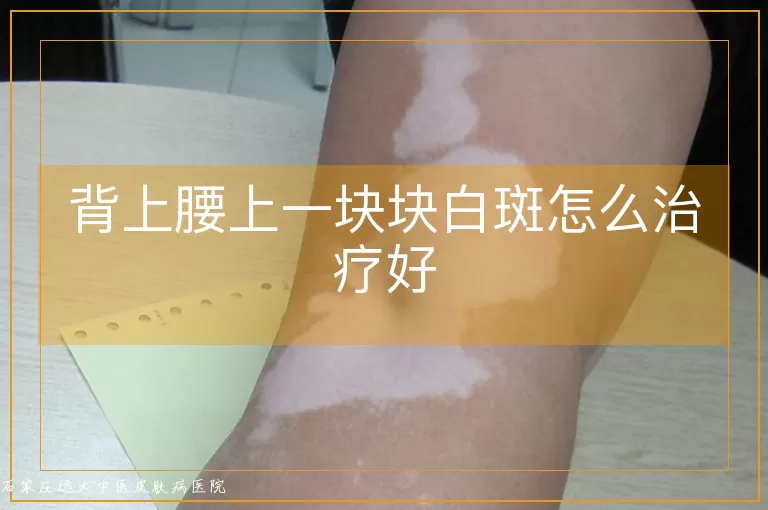 背上腰上一块块白斑怎么治疗好