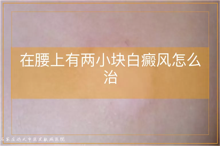 在腰上有两小块白癜风怎么治