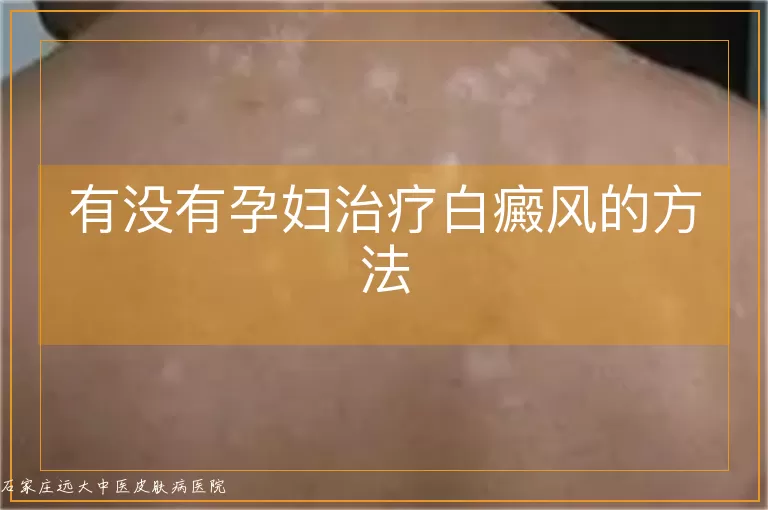 有没有孕妇治疗白癜风的方法