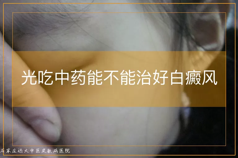 光吃中药能不能治好白癜风