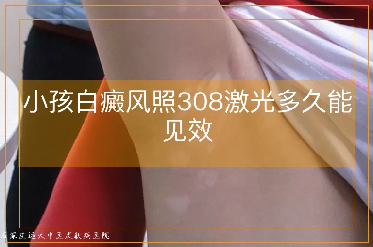 小孩白癜风照308激光多久能见效