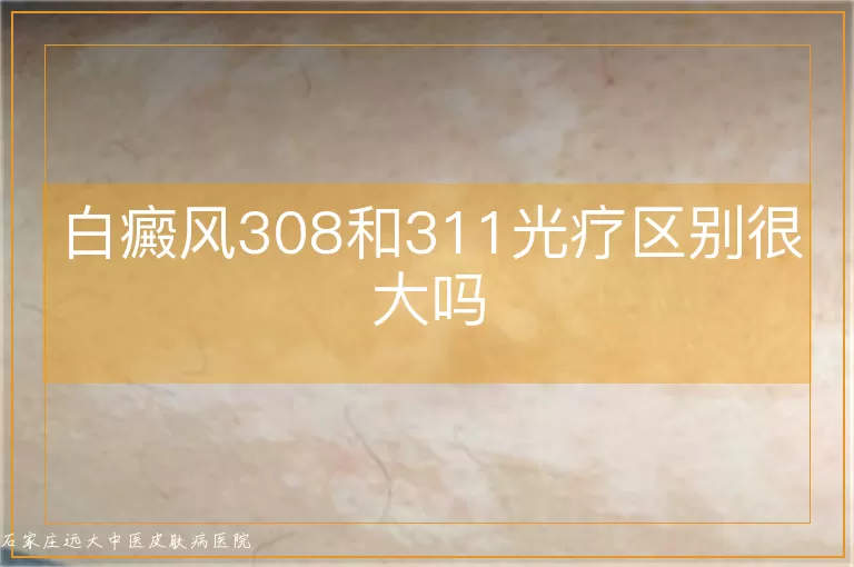 白癜风308和311光疗区别很大吗