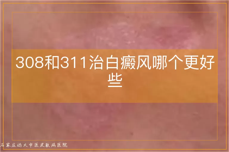 308和311治白癜风哪个更好些