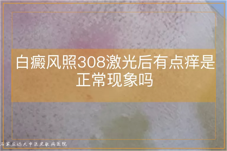白癜风照308激光后有点痒是正常现象吗