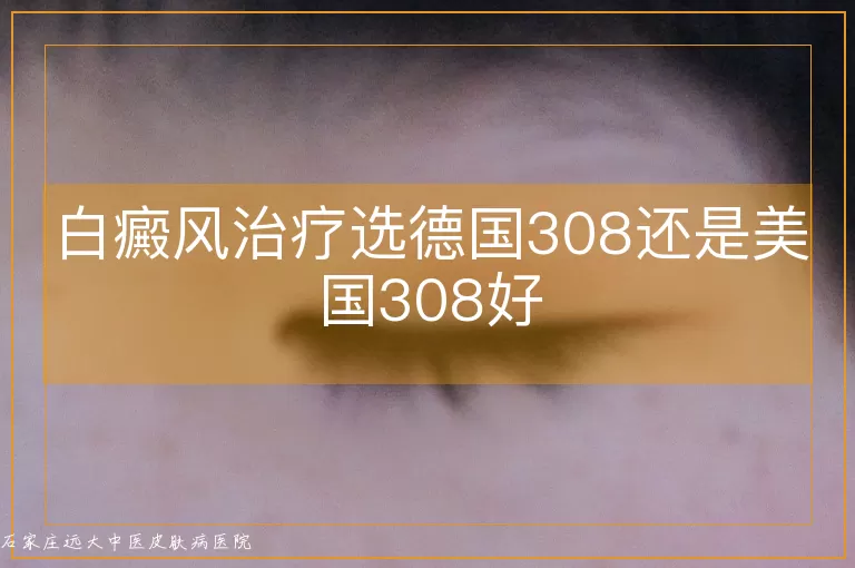 白癜风治疗选德国308还是美国308好