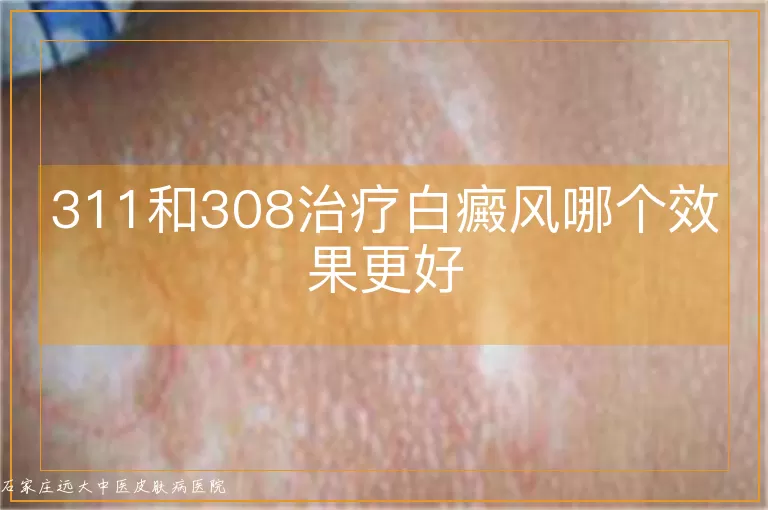 311和308治疗白癜风哪个效果更好