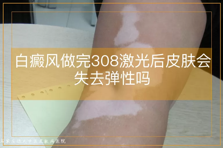 白癜风做完308激光后皮肤会失去弹性吗