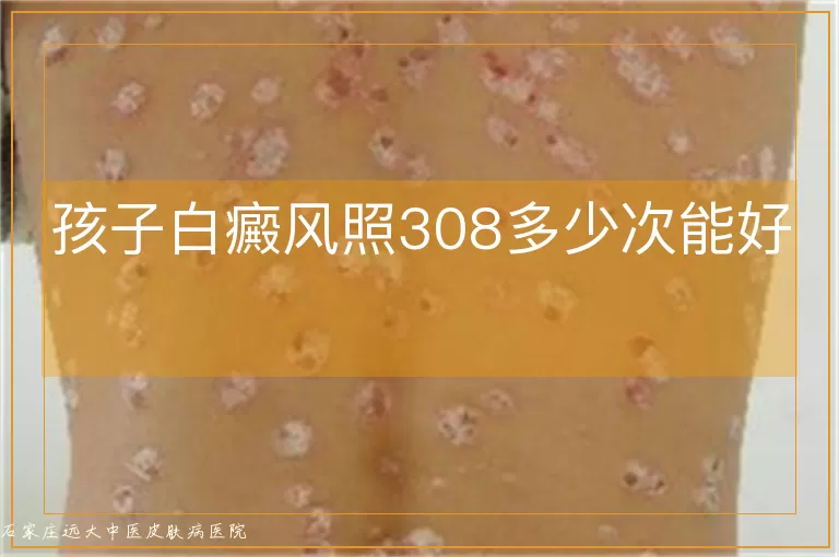 孩子白癜风照308多少次能好