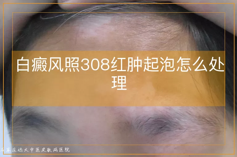 白癜风照308红肿起泡怎么处理