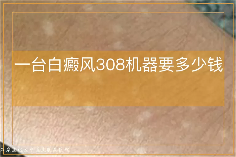 一台白癜风308机器要多少钱