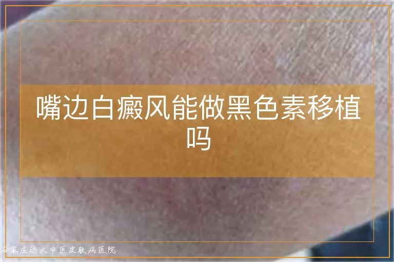 嘴边白癜风能做黑色素移植吗