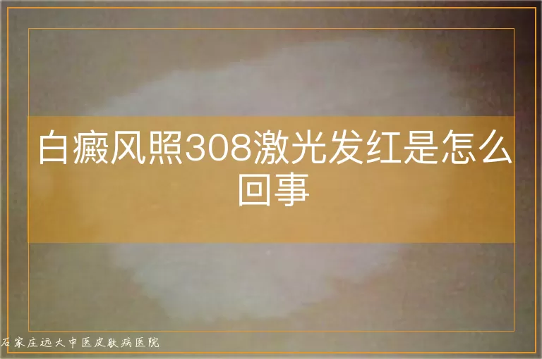 白癜风照308激光发红是怎么回事