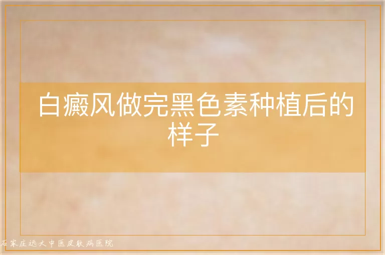 白癜风做完黑色素种植后的样子