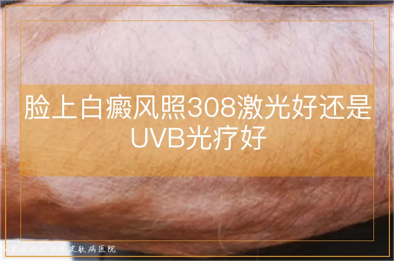 脸上白癜风照308激光好还是UVB光疗好