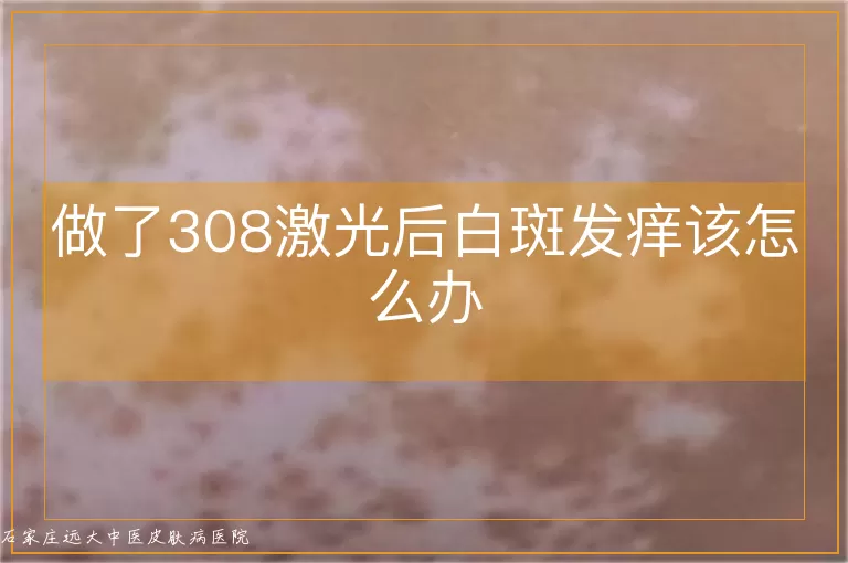 做了308激光后白斑发痒该怎么办