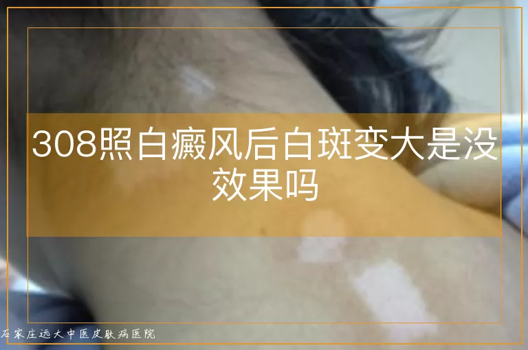 308照白癜风后白斑变大是没效果吗