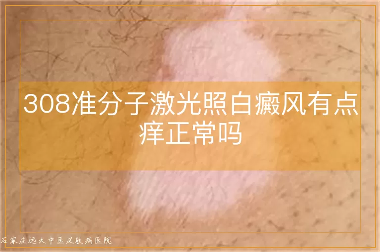 308准分子激光照白癜风有点痒正常吗