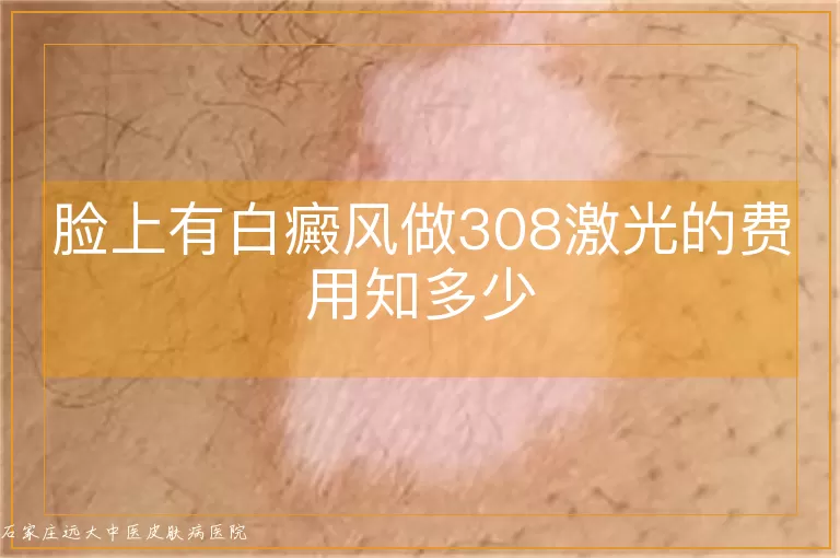 脸上有白癜风做308激光的费用知多少