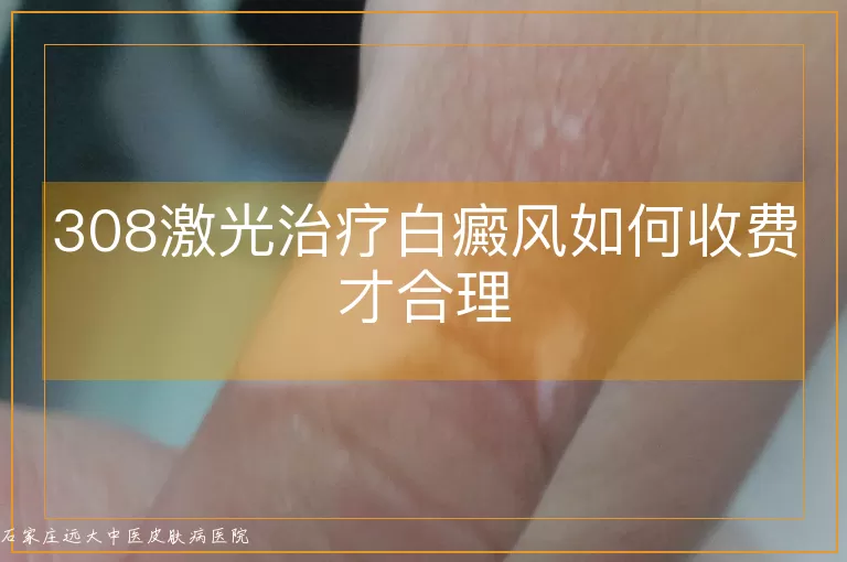 308激光治疗白癜风如何收费才合理