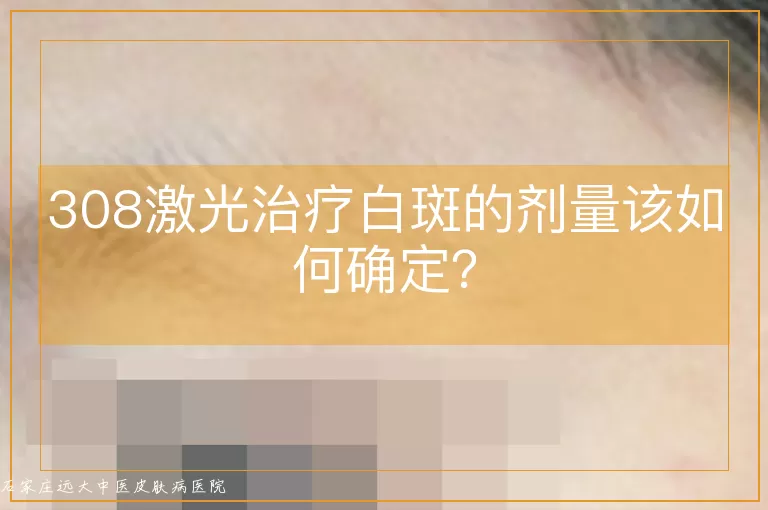 308激光治疗白斑的剂量该如何确定?