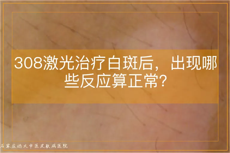 308激光治疗白斑后，出现哪些反应算正常？