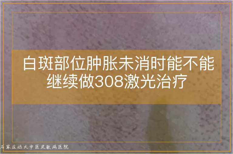 白斑部位肿胀未消时能不能继续做308激光治疗