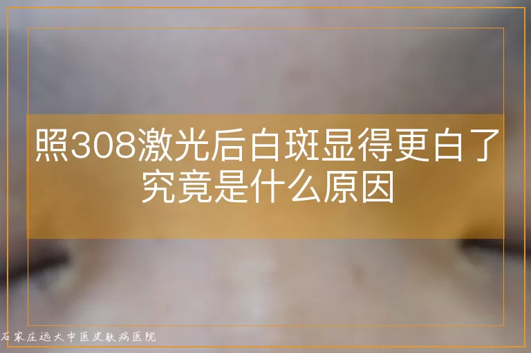 照308激光后白斑显得更白了究竟是什么原因