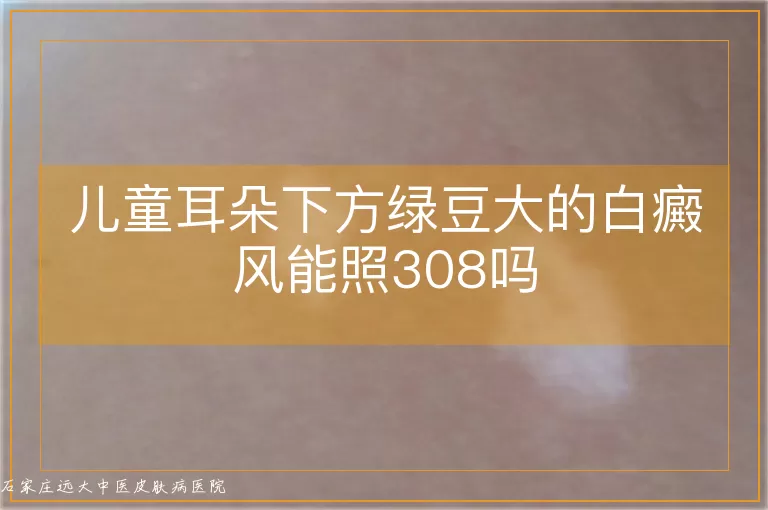 儿童耳朵下方绿豆大的白癜风能照308吗