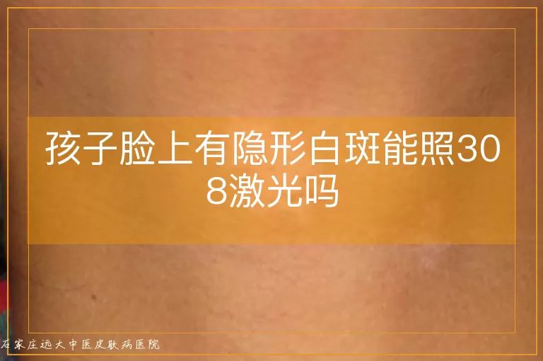 孩子脸上有隐形白斑能照308激光吗