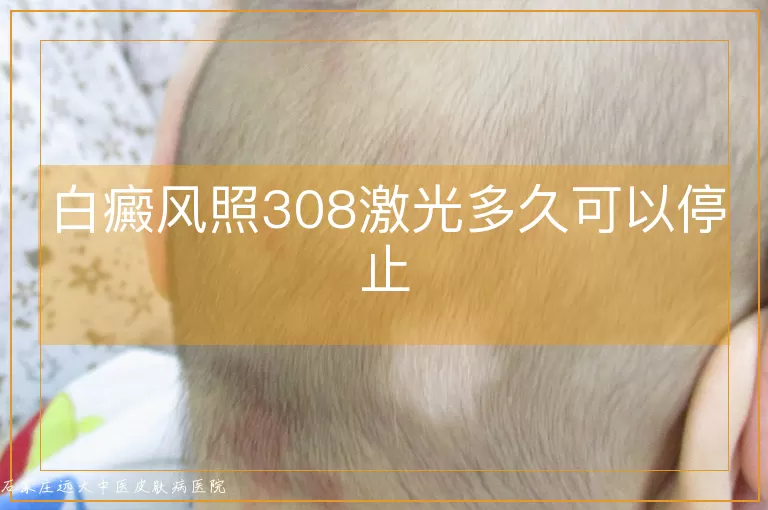 白癜风照308激光多久可以停止