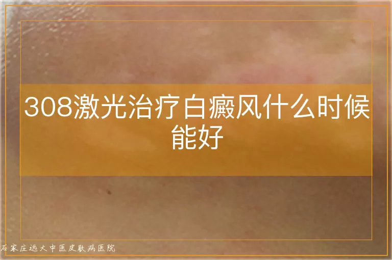 308激光治疗白癜风什么时候能好
