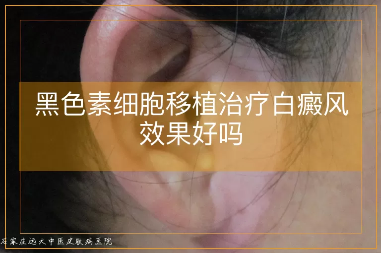 黑色素细胞移植治疗白癜风效果好吗