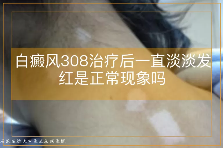 白癜风308治疗后一直淡淡发红是正常现象吗