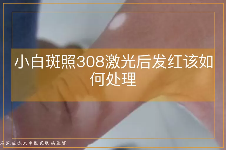小白斑照308激光后发红该如何处理