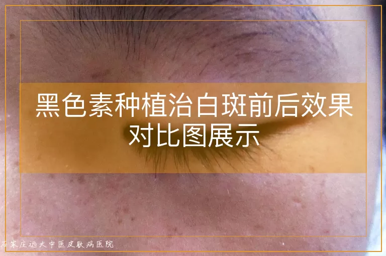 黑色素种植治白斑前后效果对比图展示