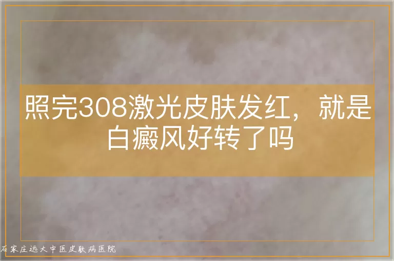 照完308激光皮肤发红，就是白癜风好转了吗