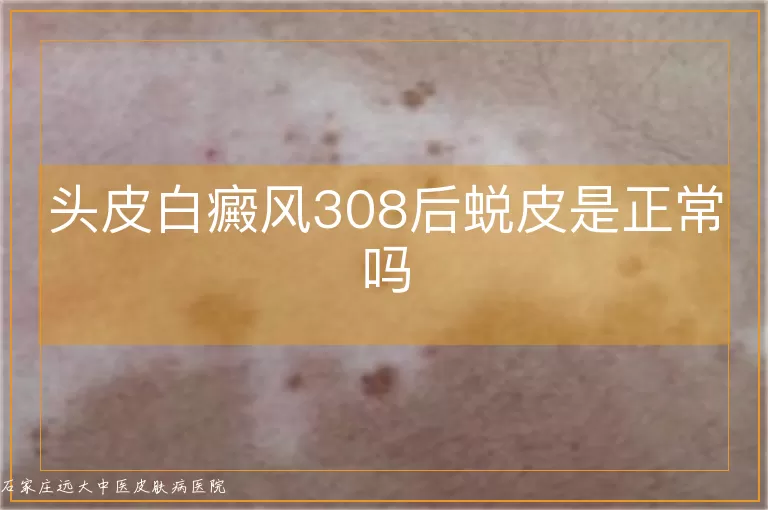 头皮白癜风308后蜕皮是正常吗