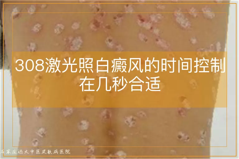 308激光照白癜风的时间控制在几秒合适