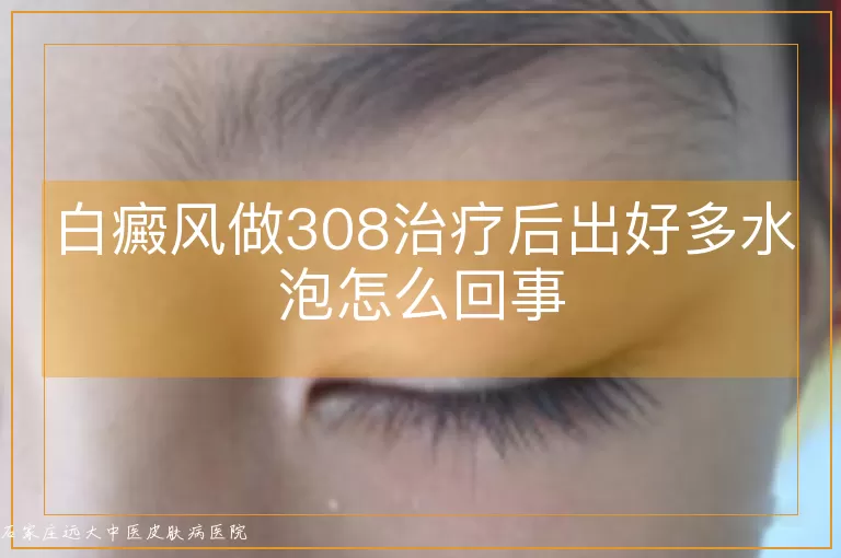 白癜风做308治疗后出好多水泡怎么回事