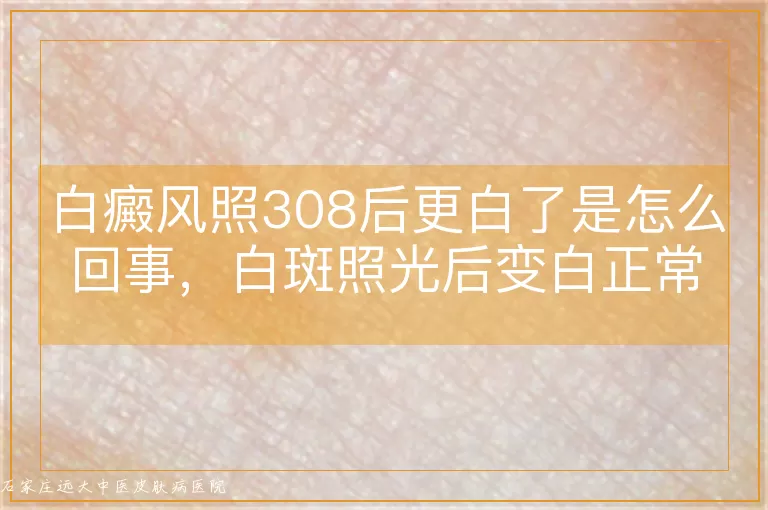 白癜风照308后更白了是怎么回事,白斑照光后变白正常吗,308激光后白斑反而更明显了