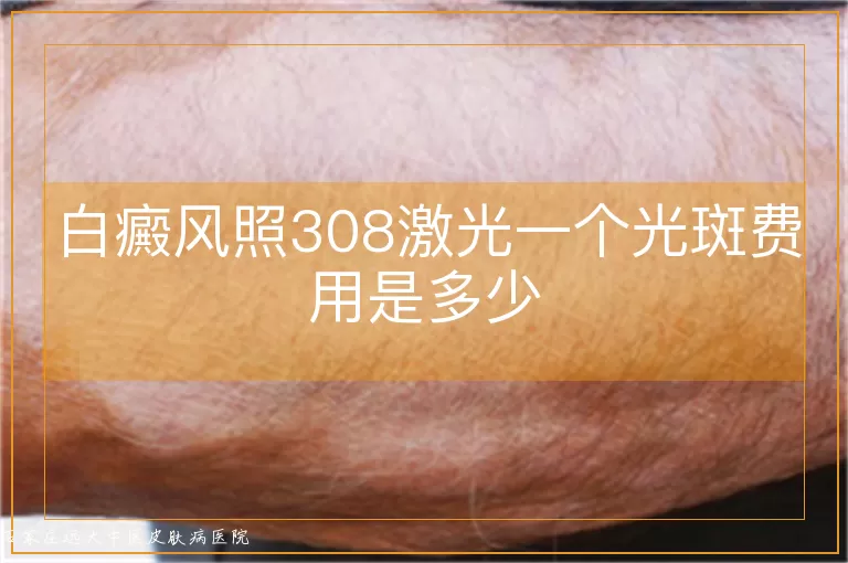 白癜风照308激光一个光斑费用是多少