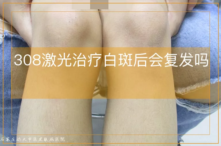 308激光治疗白斑后会复发吗