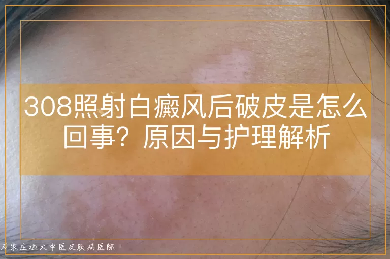 308照射白癜风后破皮是怎么回事?原因与护理解析