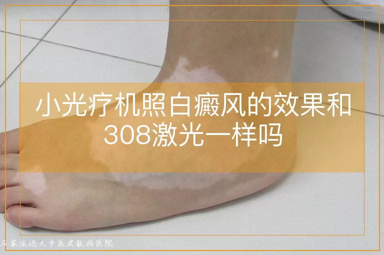 小光疗机照白癜风的效果和308激光一样吗