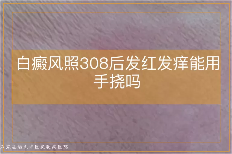 白癜风照308后发红发痒能用手挠吗